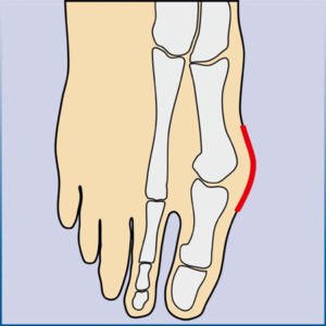 Stadien der Fußfehlstellung, Hallux Valgus, arthrolux® Korrektursocken
